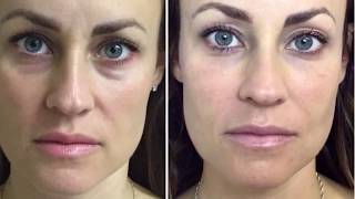 Dermal Filler Under Eyes Tear Trough [upl. by Waylin]