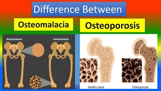 Osteroporosis and Osteomalacia [upl. by Aneeuqahs186]