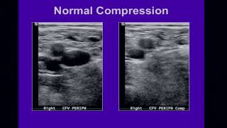 Venous Ultrasound [upl. by Eyma784]