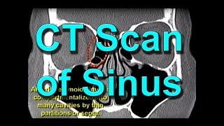 How To Read CT Sinus Scans Like An Expert [upl. by Nya]