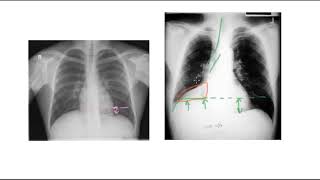 Oedèmes pulmonaires et immersion [upl. by Tollman]