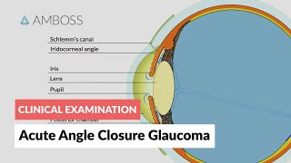 What is glaucoma [upl. by Galliett]