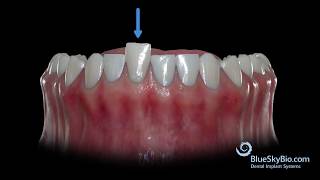 Compensatory Extrusion and Intrusion [upl. by Ennaj]