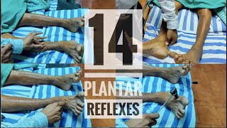 14 Abnormal plantar reflexes Babinski equivalents [upl. by Aneelahs]