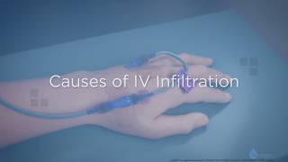 Causes of IV Infiltration  Training Video [upl. by Ehpotsirhc]