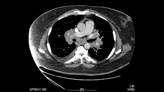 General Surgery – Mediastinal Mass By Rishindra M Reddy MD [upl. by Emmalee75]