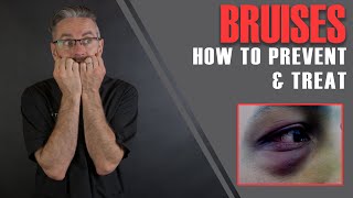 FILLER BRUISES Dr Tims 16 Essential Tips To Prevent amp Minimise Bruises Aesthetics Mastery Show [upl. by Berkly814]