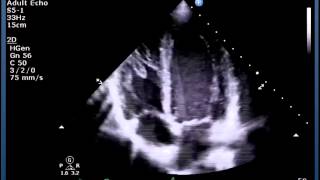 Understanding Mitral Stenosis Signs and Symptoms [upl. by Eulau317]