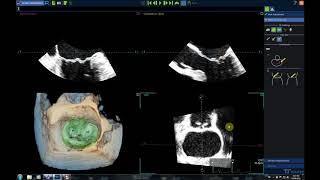 Tricuspid Valve Papillary Fibroelastoma [upl. by Lika]