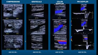 Radiofrequency Fibre In Action  RFA Vein Treatment [upl. by Cheke]