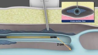 Understanding and Diagnosing Venous Thromboembolism VTE [upl. by Natsud]