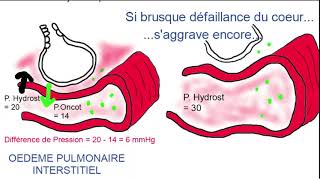 Oedème pulmonaire [upl. by Ahc]