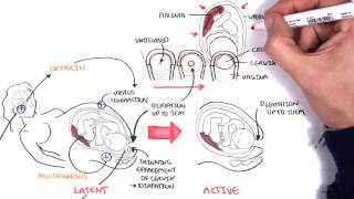 Causes Behind Premature Births [upl. by Powers]