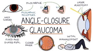 How To Improve Glaucoma – DrBerg On Glaucoma Treatment [upl. by Fiorenze]