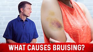 How to Cover Up a Bruise [upl. by Kella]