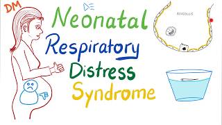 Neonatal Respiratory Distress Syndrome NRDS  Pediatrics  Pulmonology [upl. by Karena]