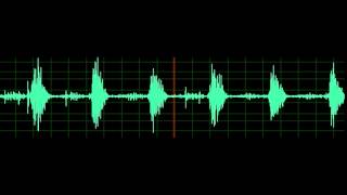 Crackles Pulmonary Edema [upl. by Anaehr]