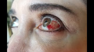 What Causes Blood in the Eye [upl. by Jacklin]