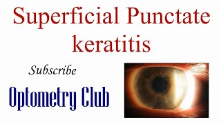 Superficial Punctate Keratitis Introduction Diagnosis and Treatment [upl. by Aiva]