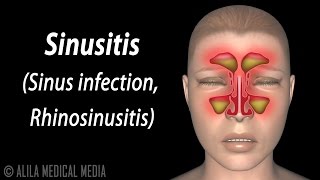 Sinusitis Animation [upl. by Tselec]